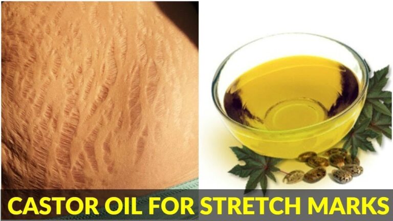 Castor Oil for Stretch Marks- Learn How Castor Oil Can Reduce or Eliminate Your Strech Marks.